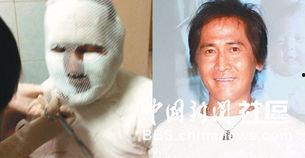 明星网红针灸,网红针灸养生风潮揭秘